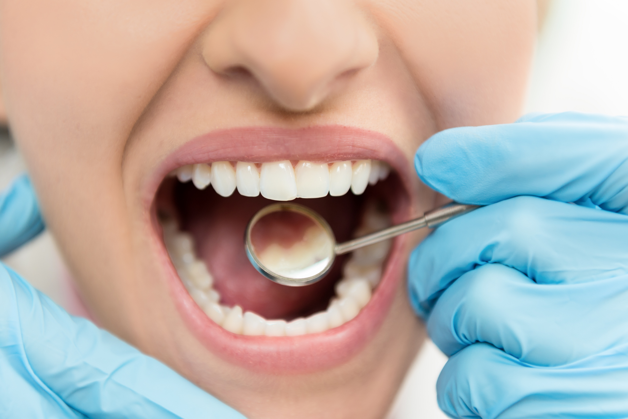 Caries dental