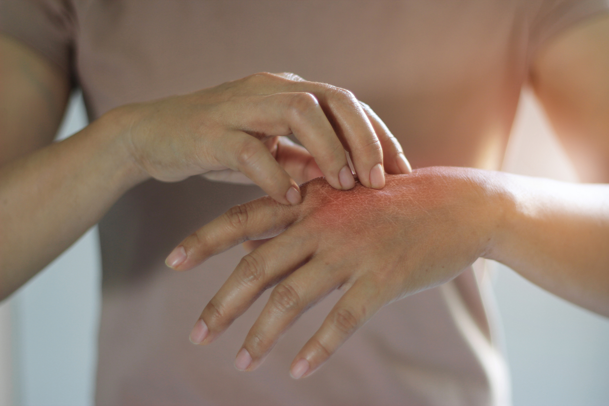 Esclerodermia