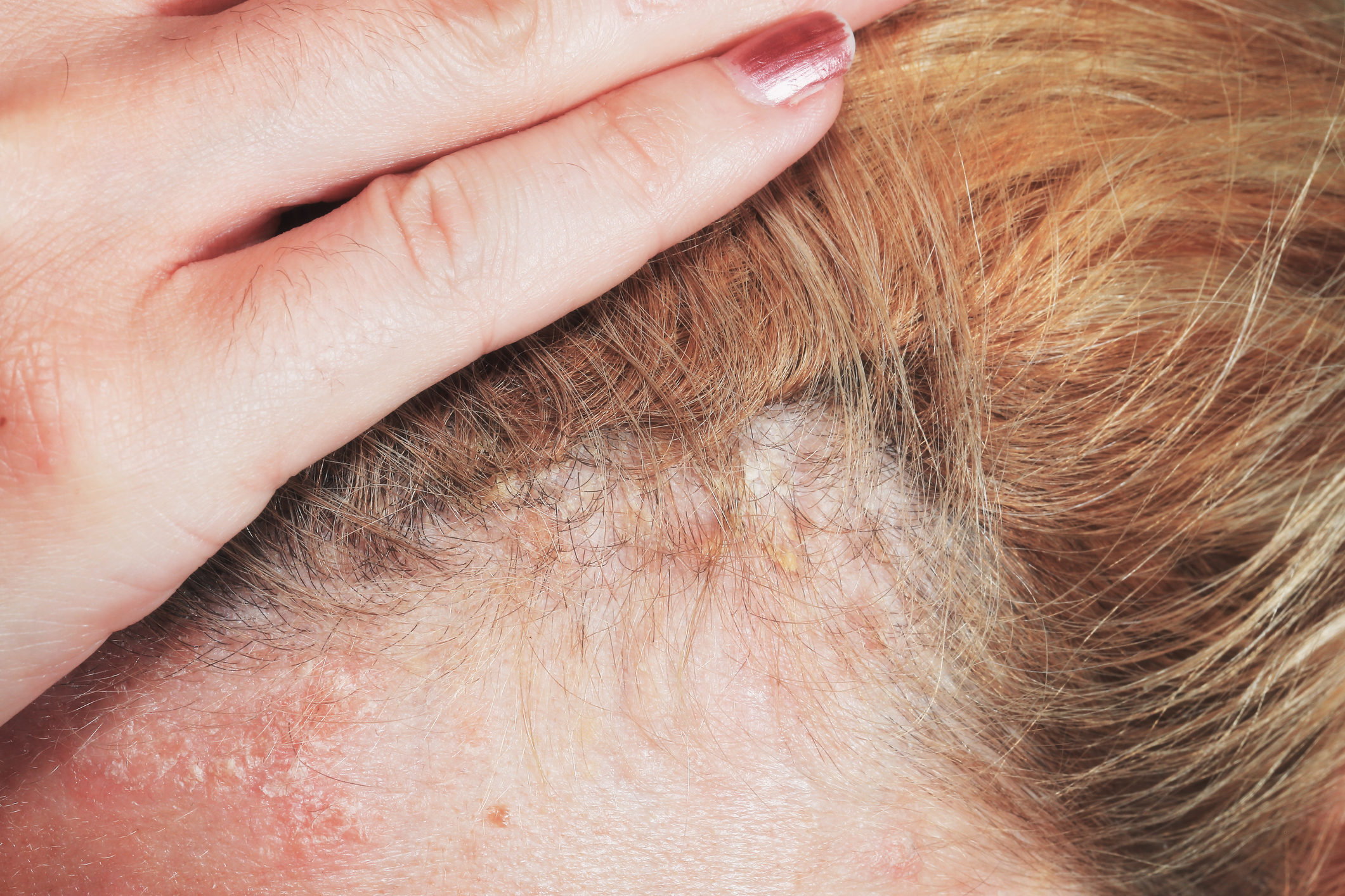 Síntomas principales y tratamientos de la psoriasis