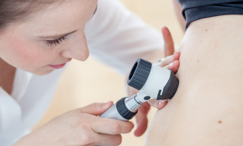 Cómo prevenir el cáncer de piel