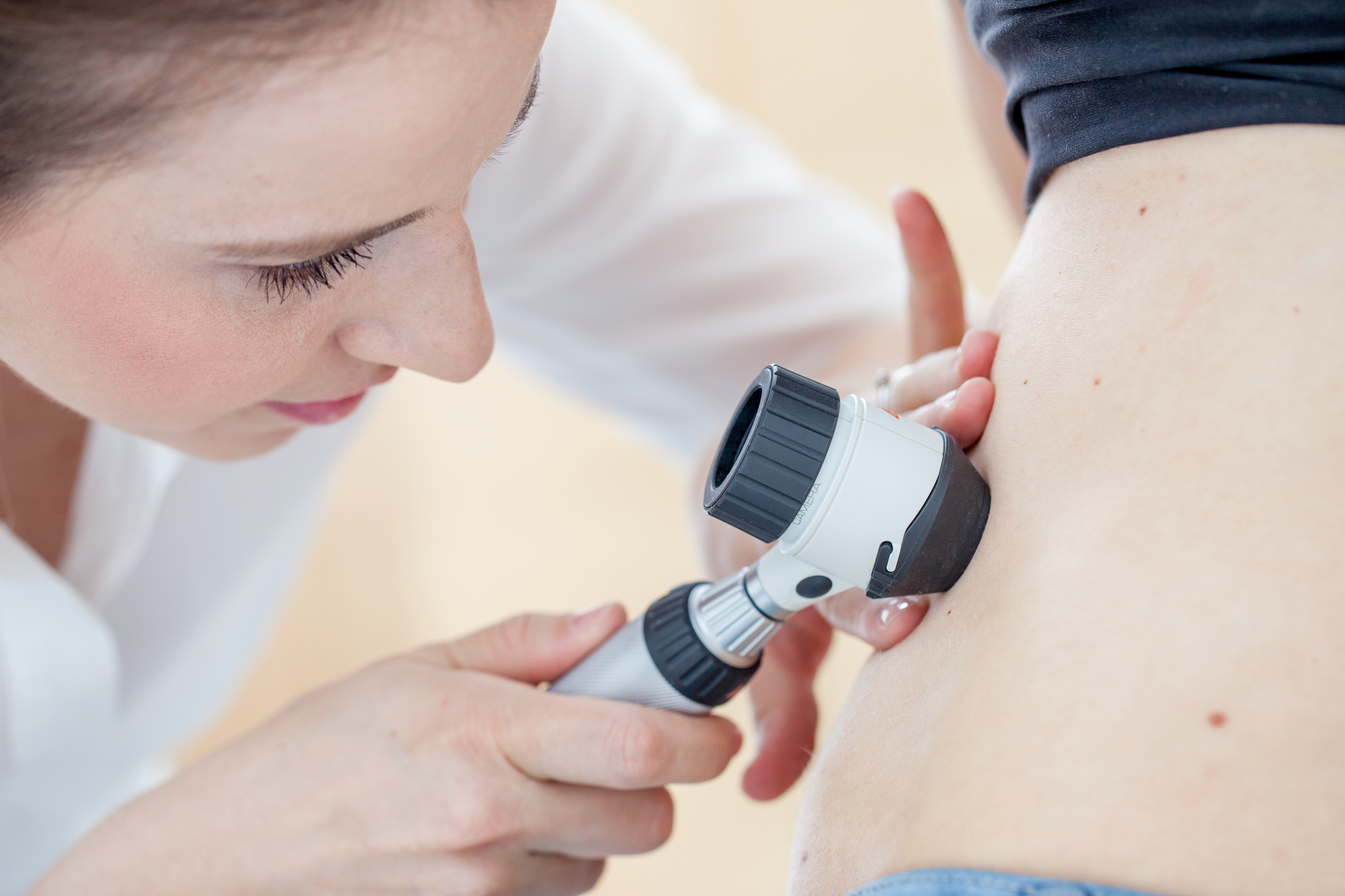 Cómo prevenir el cáncer de piel