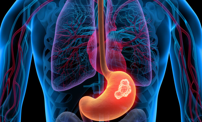 Cáncer gástrico