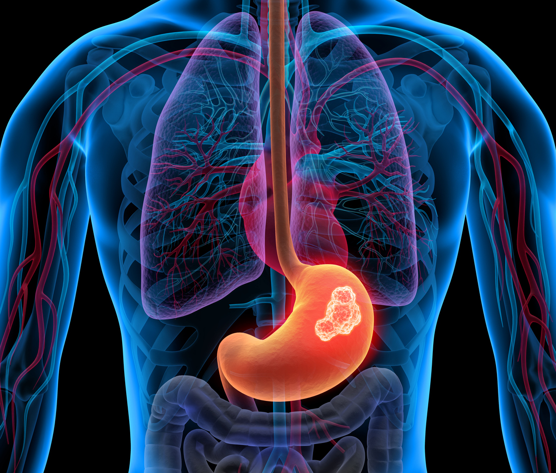 Cáncer gástrico