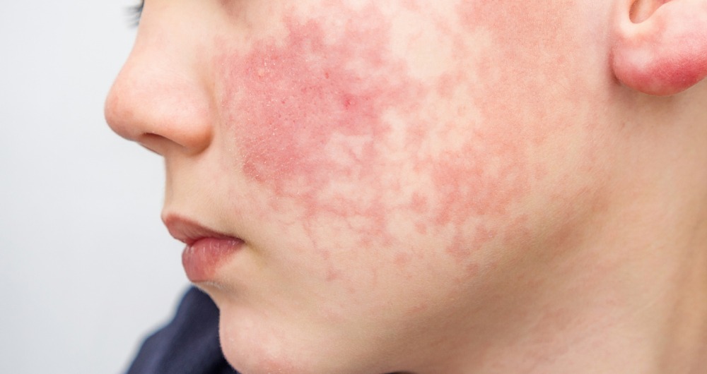 Dermatitis atópica: todo lo que debes saber