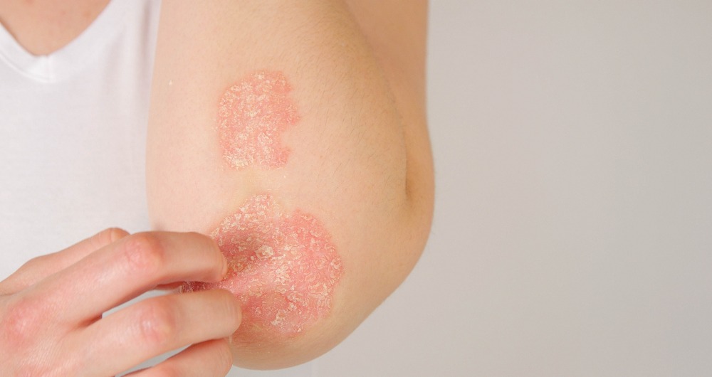 Conociendo la psoriasis