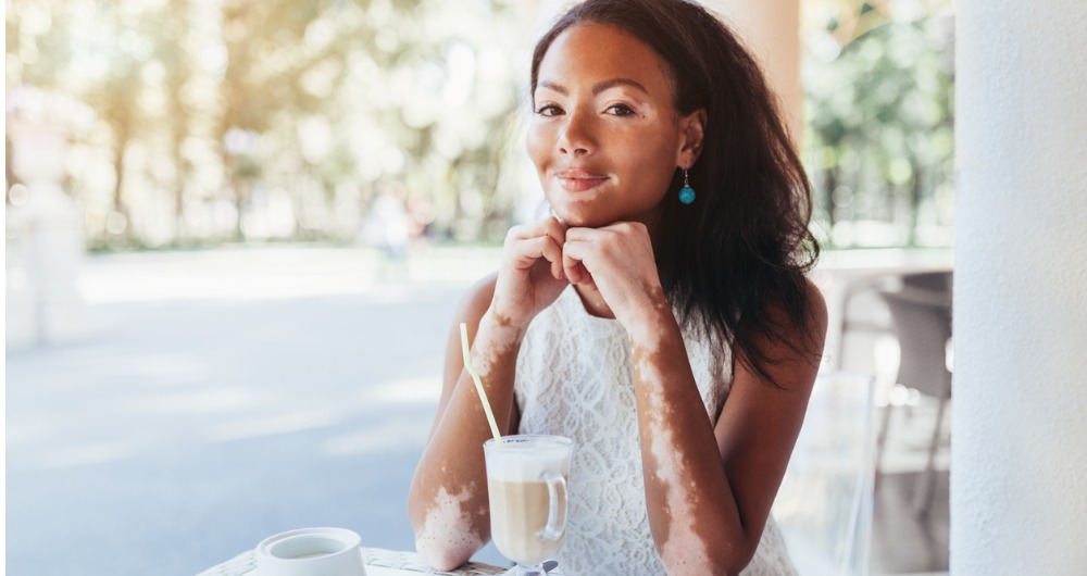 ¿Qué debemos saber sobre el vitiligo