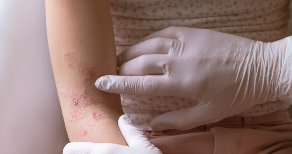 Doctor apuntando a los signos de dermatitis atópica en el brazo de una joven