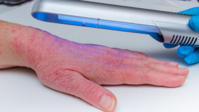 Tratamientos para la dermatitis atópica