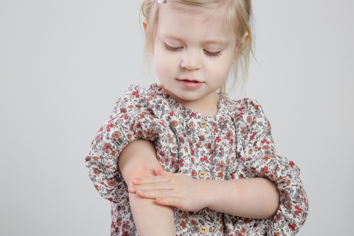 Psoriasis en los niños