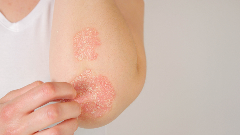 Dermatitis seborreica