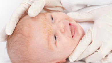 Es una afección cutánea, inflamatoria y común. Provoca que se formen escamas, que van de blancas a amarillentas, en áreas grasosas como el cuero cabelludo, la cara o dentro del oído. Puede ocurrir con o sin enrojecimiento cutáneo.