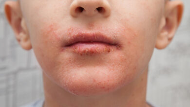 El impétigo es una infección cutánea muy contagiosa que afecta principalmente a los bebés y a los niños pequeños.