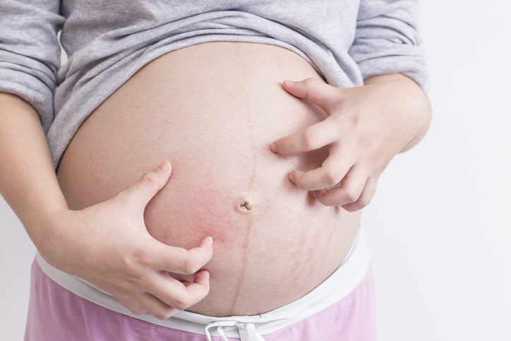 dermatitis atópica en el embarazo