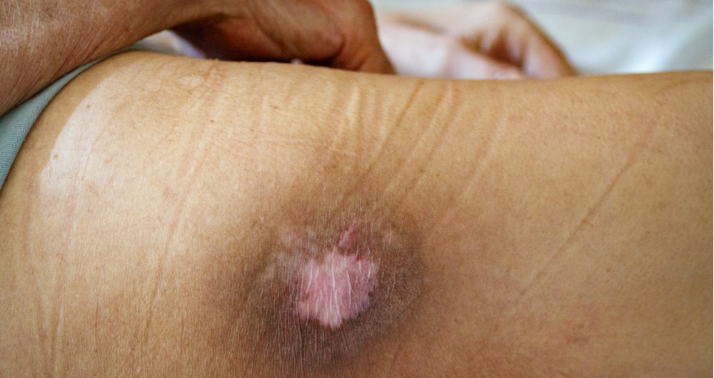 Formas de prevenir la lesion por presion