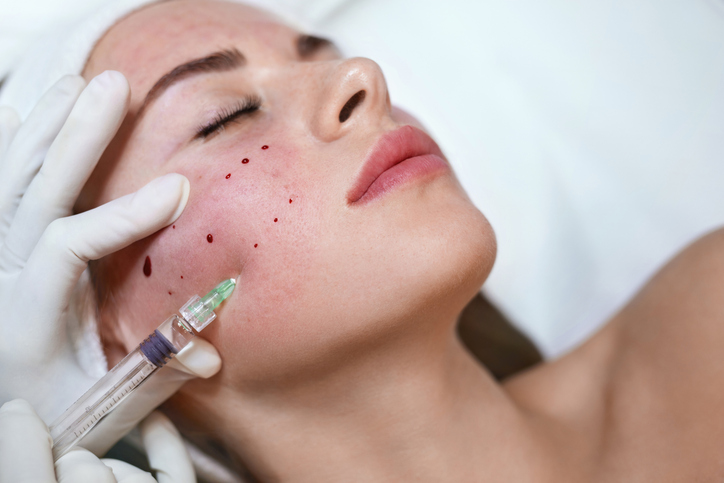 Los investigadores determinaron que 59 clientes podrían haber estado expuestos al VIH, de los cuales 20 recibieron tratamientos faciales vampiro.