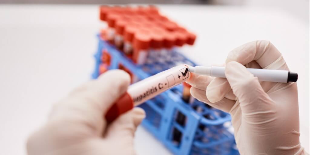 Retos y oportunidades de Puerto Rico en la eliminación de la hepatitis C
