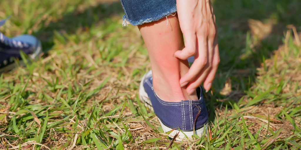 Dermatitis