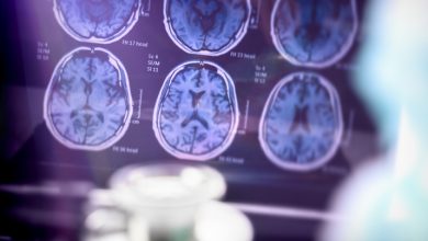 Una rara mutación genética ayuda a las personas a resistir la enfermedad de Alzheimer