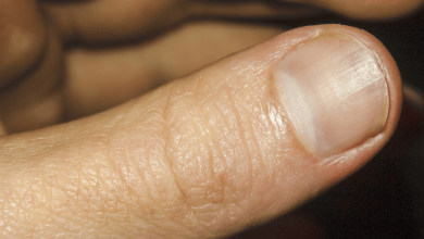 Psoriasis