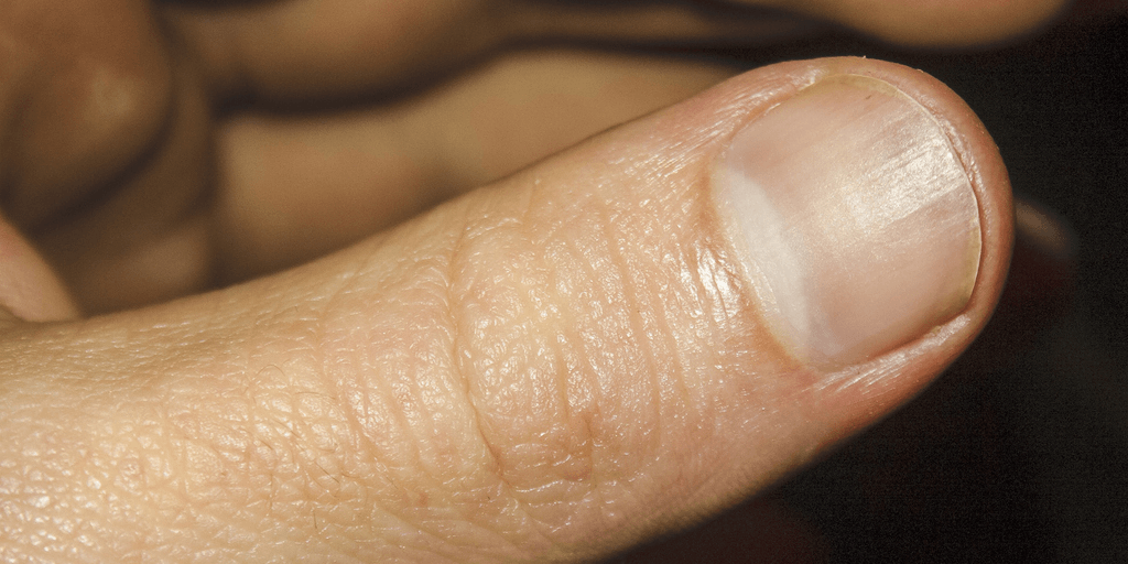 Psoriasis