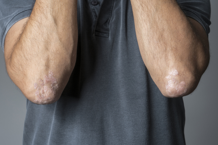 artritis psoriásica simetrica