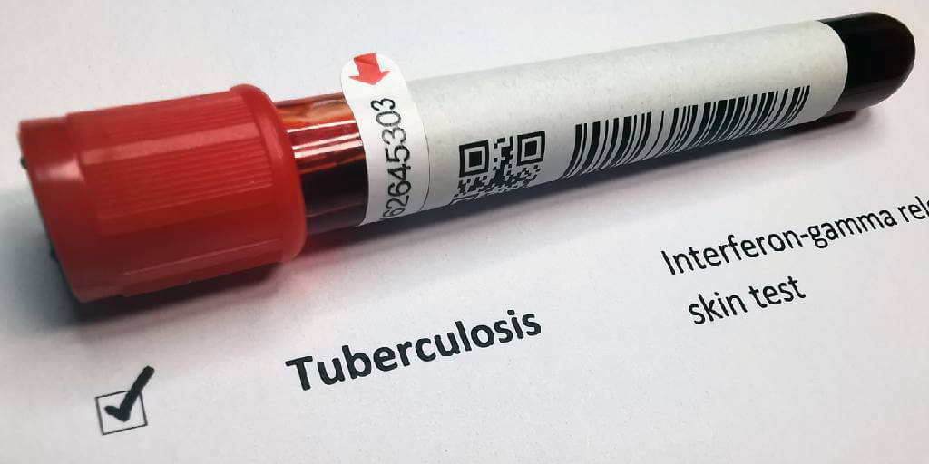 Tuberculosis, una infección en alarma