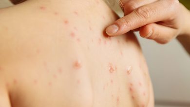 Síntomas del herpes zóster: cómo reconocer esta infección viral