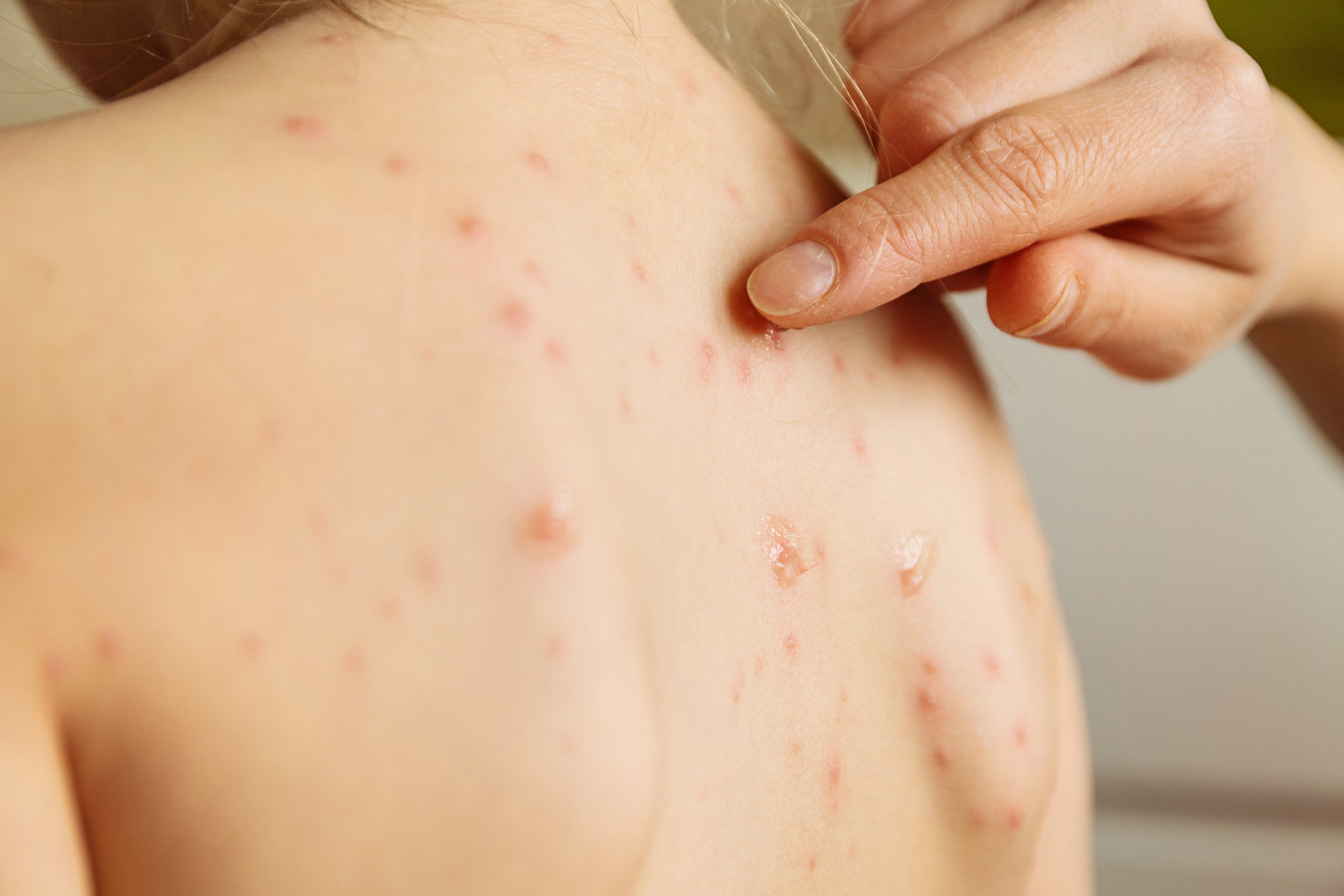 Síntomas del herpes zóster: cómo reconocer esta infección viral