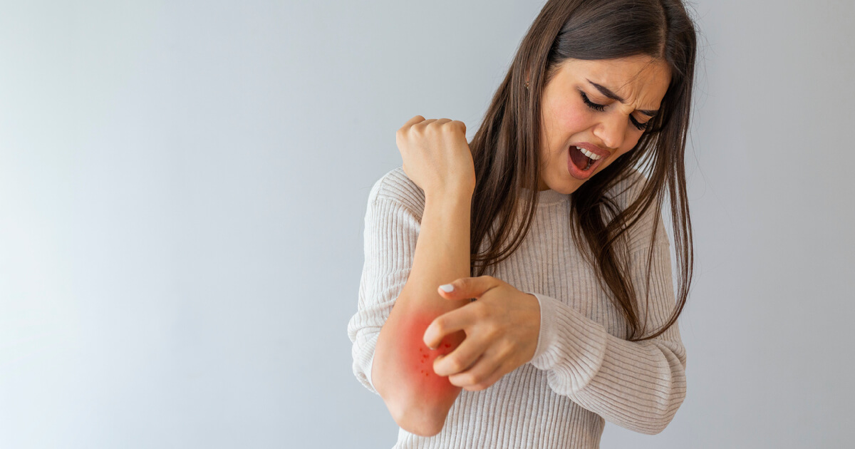 Psoriasis