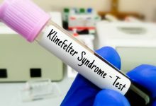 El síndrome de Klinefelter es una condición genética en la que los hombres tienen un cromosoma X extra