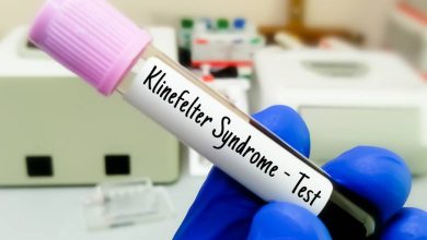 El síndrome de Klinefelter es una condición genética en la que los hombres tienen un cromosoma X extra