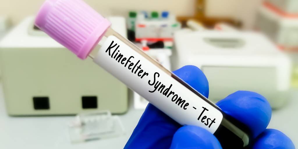 El síndrome de Klinefelter es una condición genética en la que los hombres tienen un cromosoma X extra