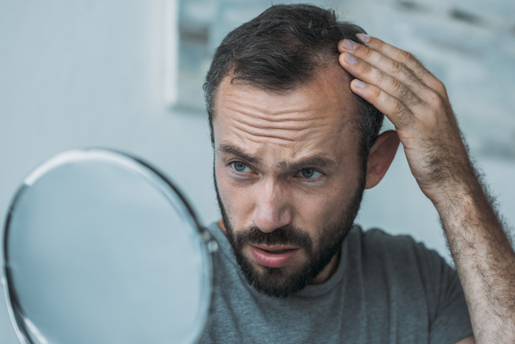 Alopecia es un término genérico que engloba las afecciones caracterizadas por la caída del cabello.