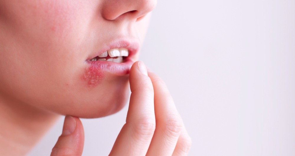 Conoce los síntomas del herpes genital