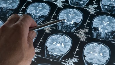 Primer caso de alzheimer en joven de 19 años