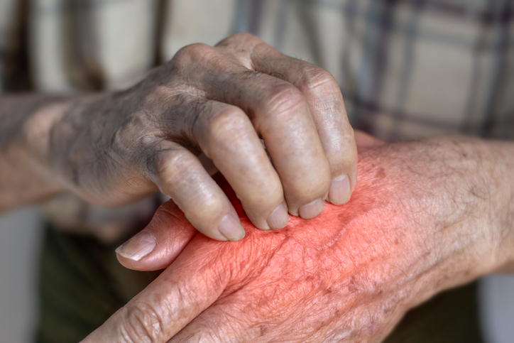 La lepra es una enfermedad infecciosa crónica causada por la bacteria Mycobacterium leprae.