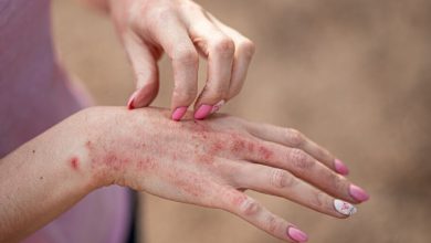 La psoriasis es una patología crónica que supone un importante impacto en la calidad de vida y salud emocional del paciente.