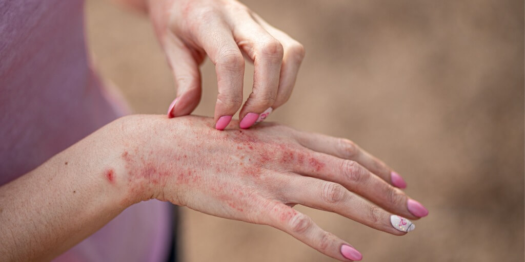 La psoriasis es una patología crónica que supone un importante impacto en la calidad de vida y salud emocional del paciente.