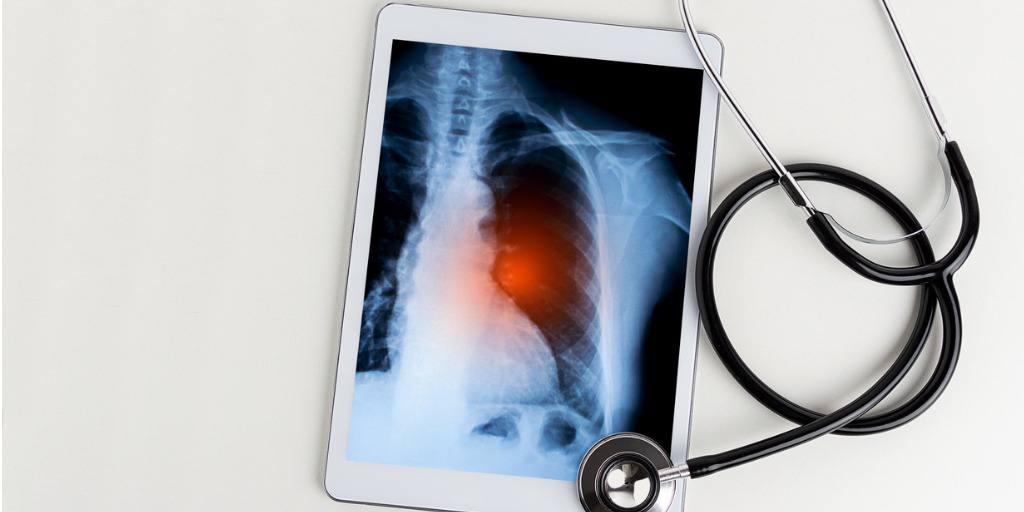 Las bacterias de la tuberculosis pueden vivir en su cuerpo sin que usted se enferme. Esto se denomina infección de tuberculosis latente.